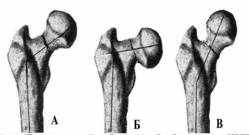 Перелом шейки бедренной кости. Варусный перелом шейки бедра. Переломы головки и шейки бедренной кости рентген. Вколоченный перелом бедренной кости. Шейка правой бедренной кости со смещением.